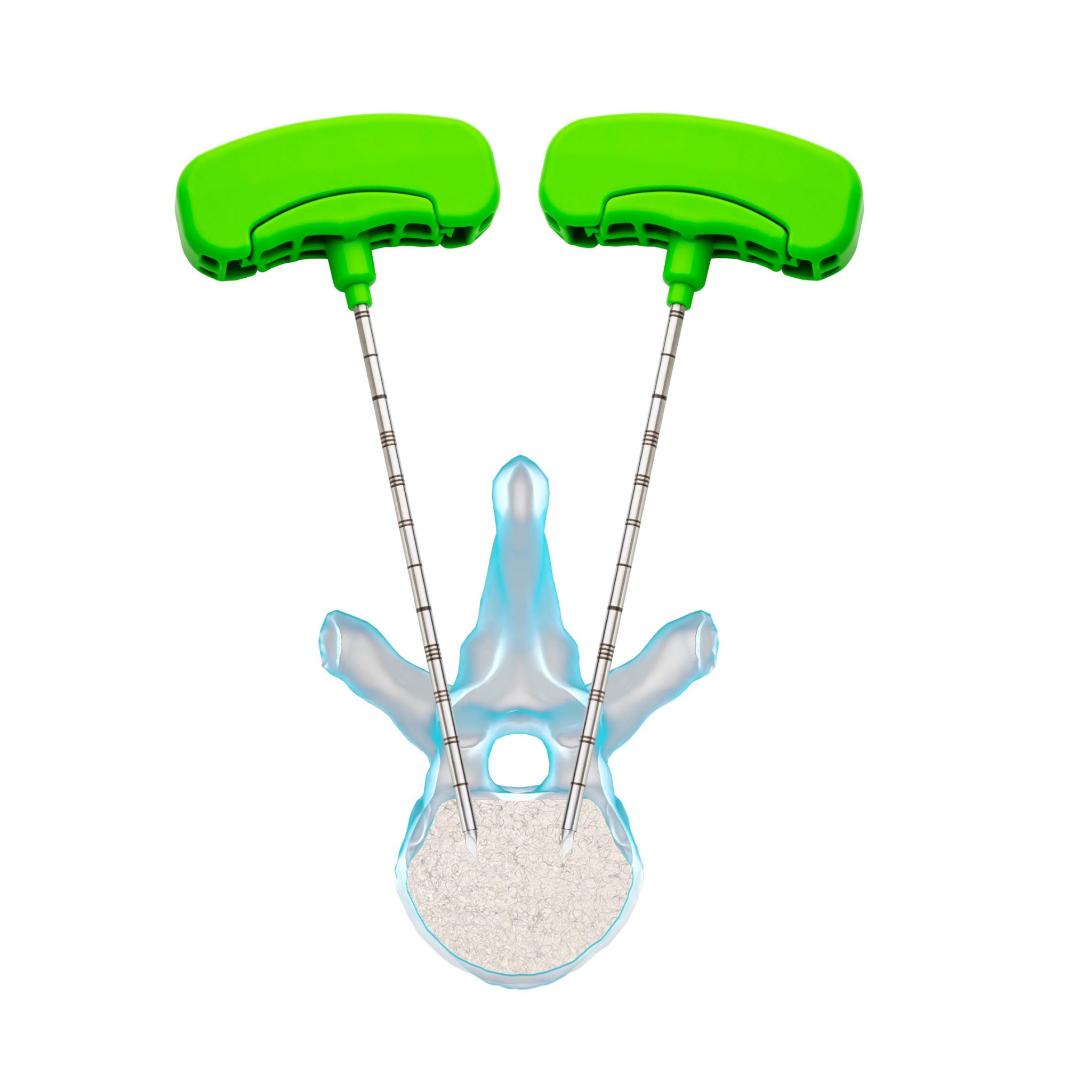 KYPHOPLASTY PROCEDURE BPB MEDICA™ Biopsybell