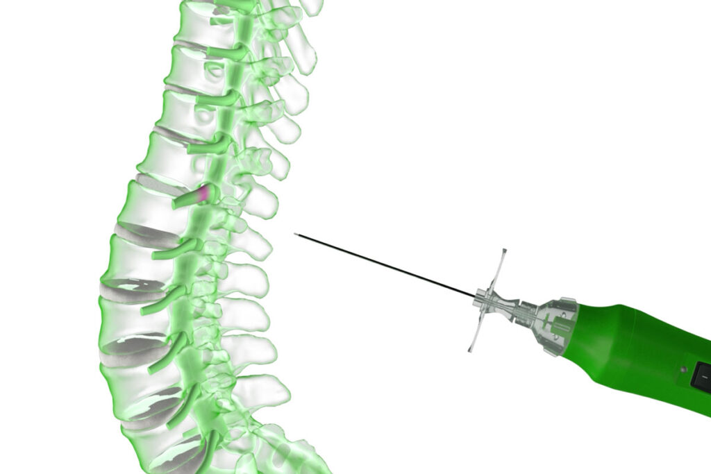 PERCUTANEOUS DISCECTOMY - BPB medica