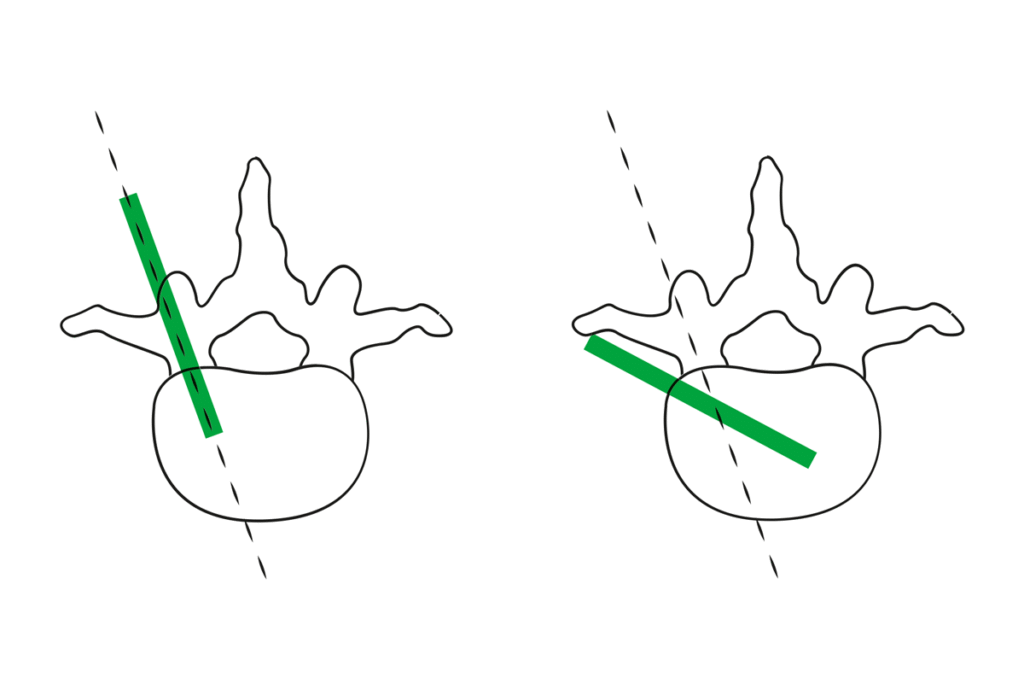 VERTEBROPLASTY PROCEDURE - BPB medica