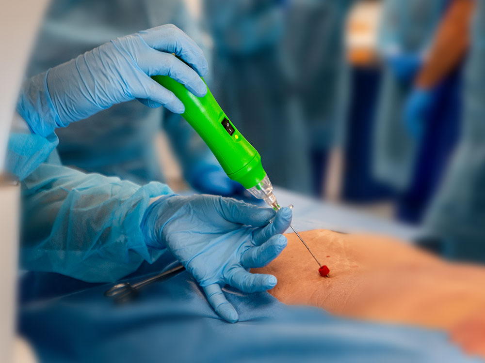 Percutaneous discectomy, minimally invasive procedure with DISKOM™