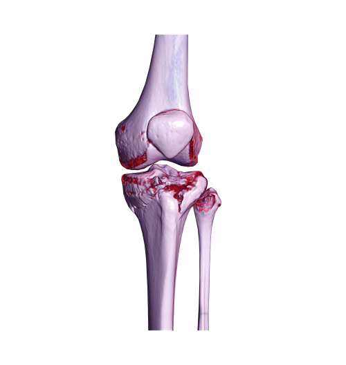 Depositphotos_618747500_XL CT rendering image showing fracture tibia bone
