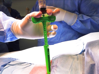 Close-up of the MARROW-STEM™ device in use during sterile bone marrow aspiration.