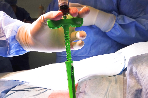 Close-up of the MARROW-STEM™ device in use during sterile bone marrow aspiration.