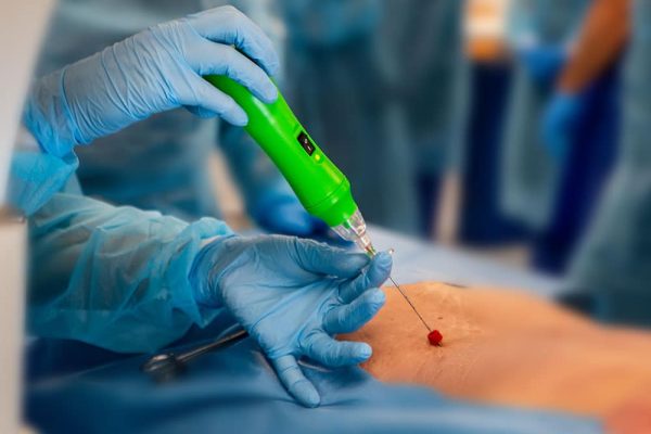Percutaneous discectomy, minimally invasive procedure with DISKOM™