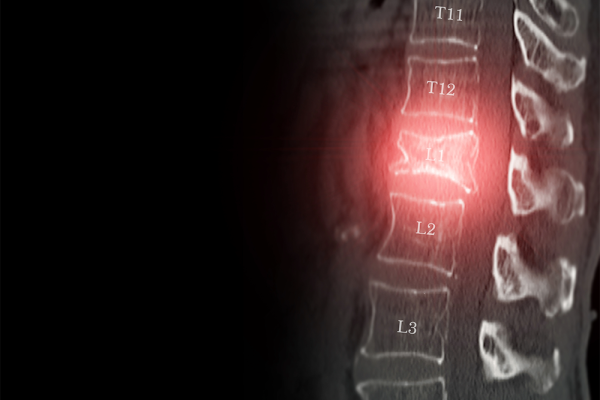 Vertebral Compression Fracture
